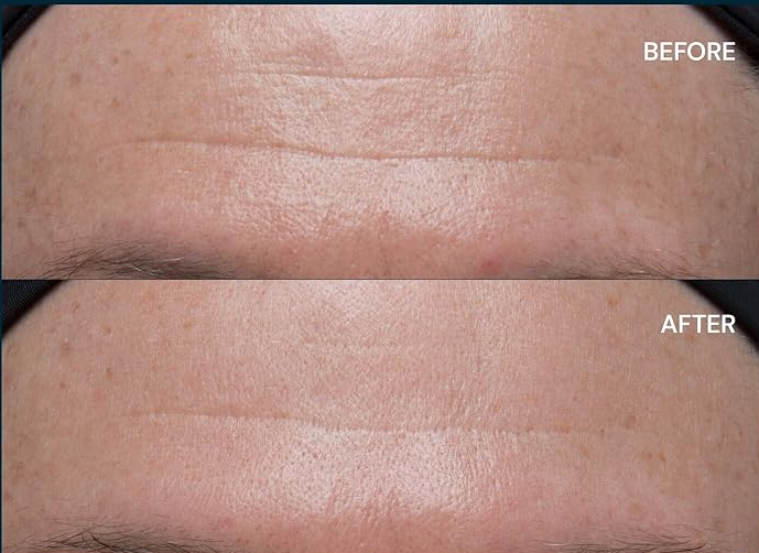 Cloud Cream results before and after