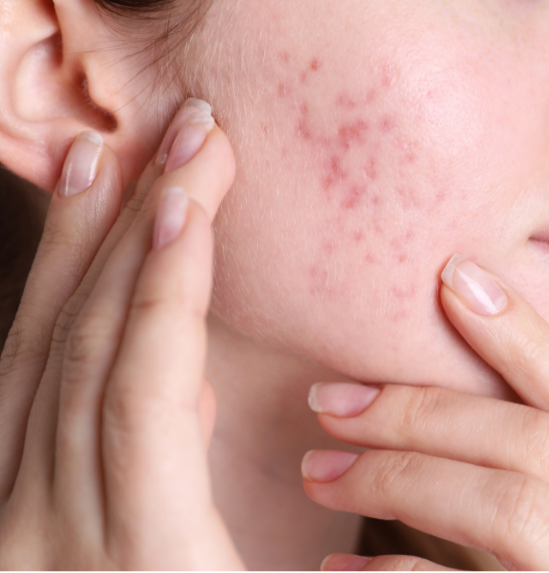 woman with face acne showin her results